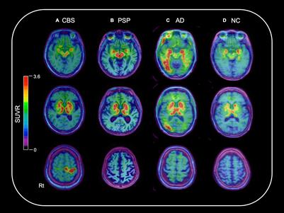 18F-THK5351 Positron Emission Tomography Imaging in Neurodegenerative Tauopathies